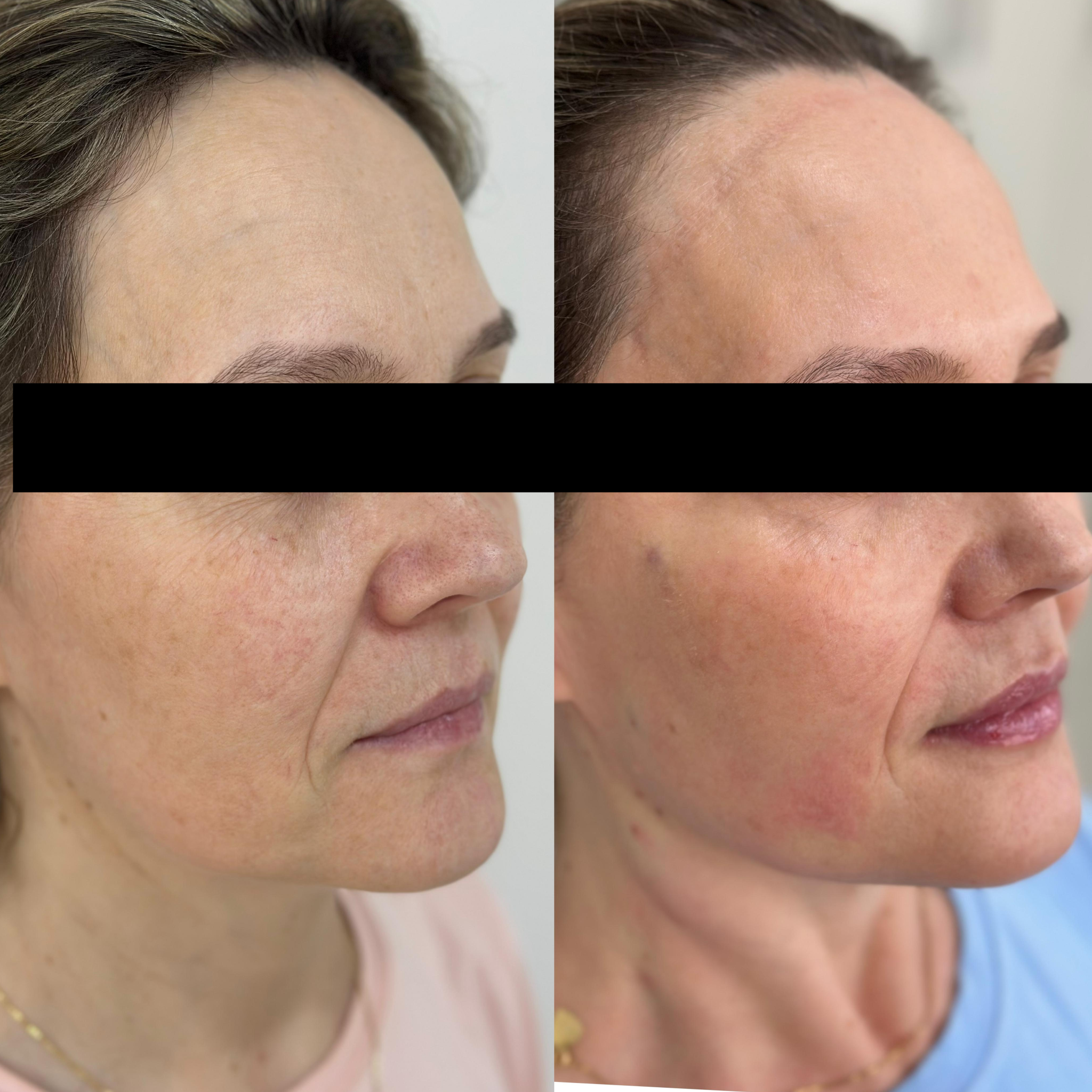 Bioestimulador de Colágeno