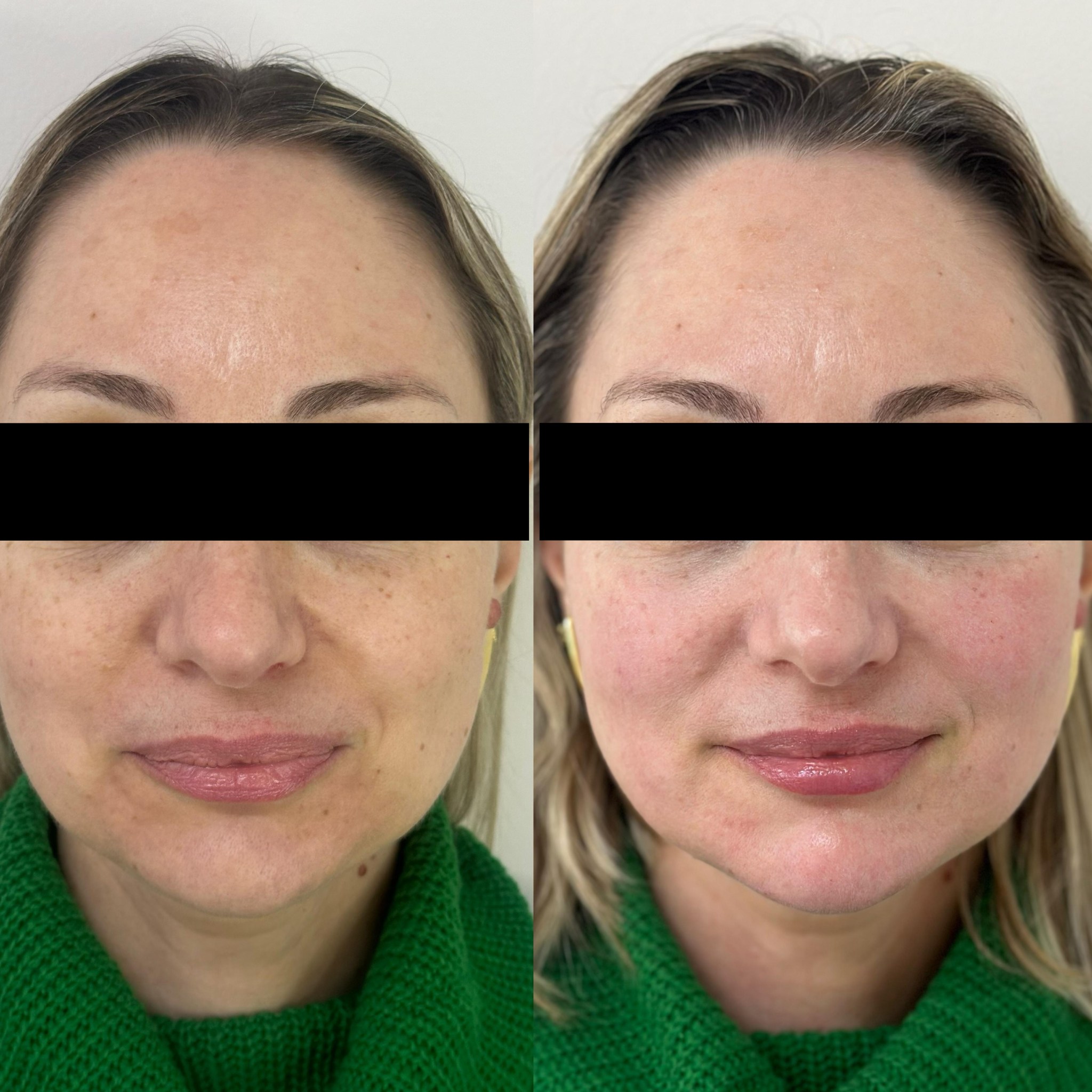 Harmonização Facial