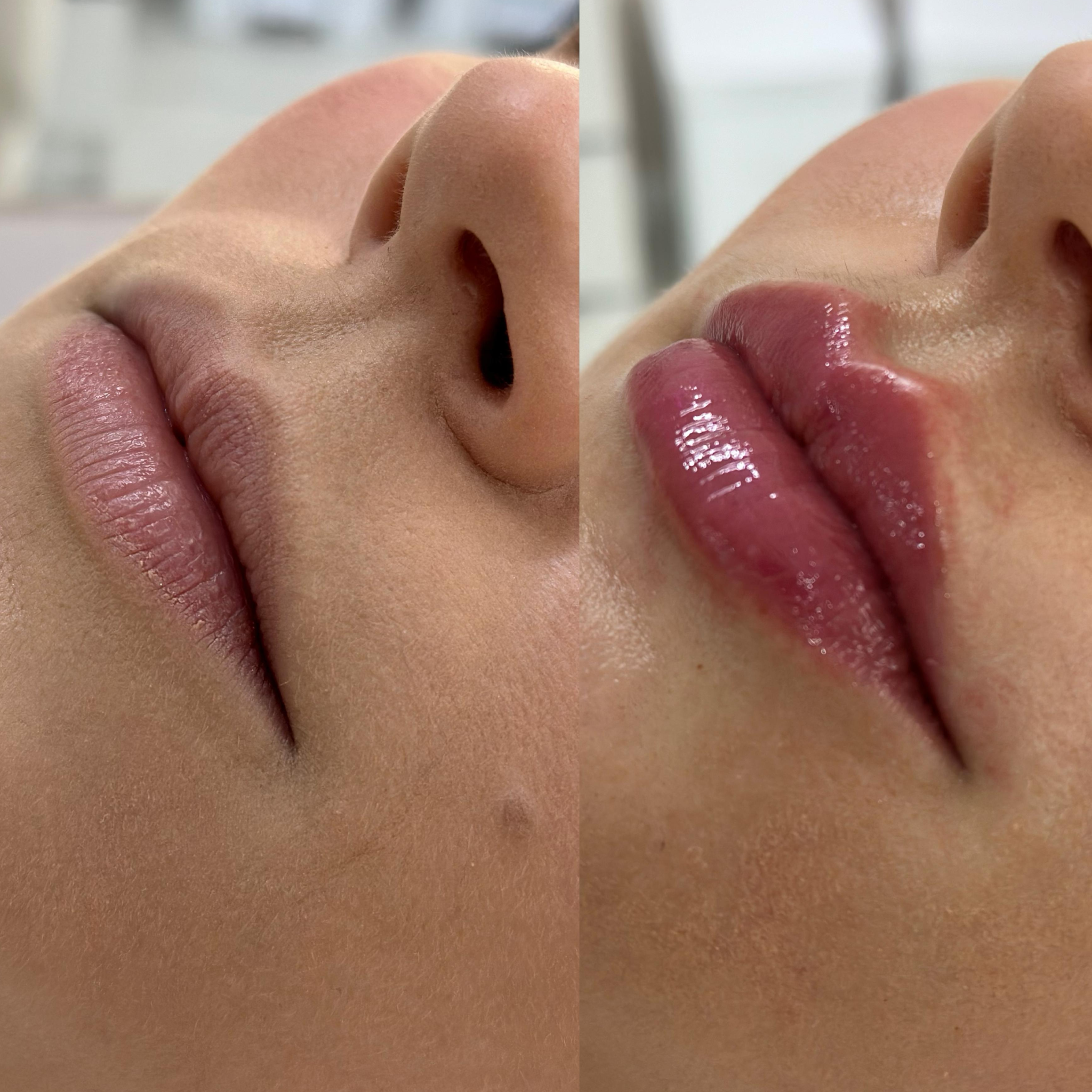 Preenchimento Labial