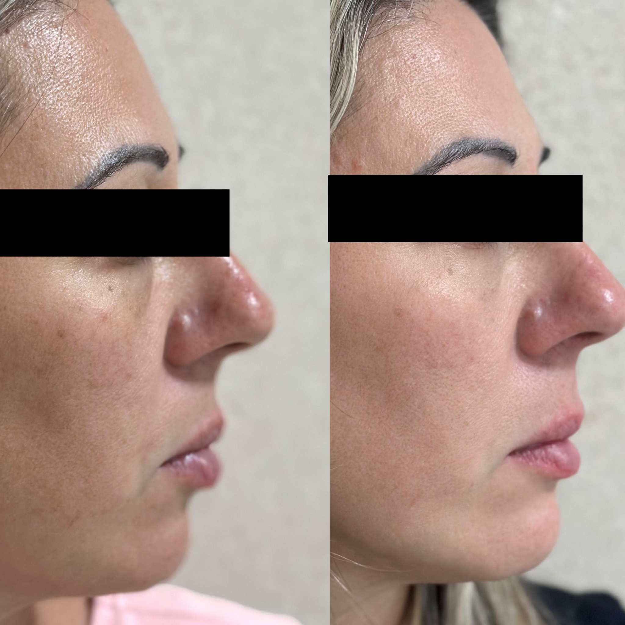 Preenchimento Malar e Mento